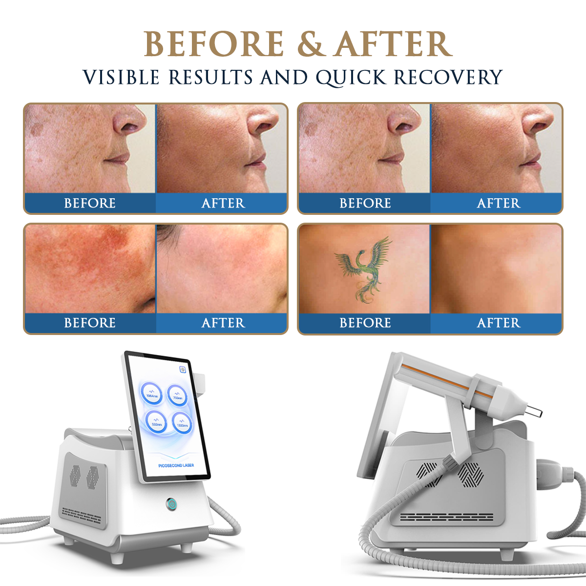 Skin Monarch Picosecond Tattoo Removal Laser 1500W machine with digital display and sleek design for professional tattoo removal treatments.