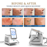Skin Monarch Picosecond Tattoo Removal Laser 1500W machine with digital display and sleek design for professional tattoo removal treatments.